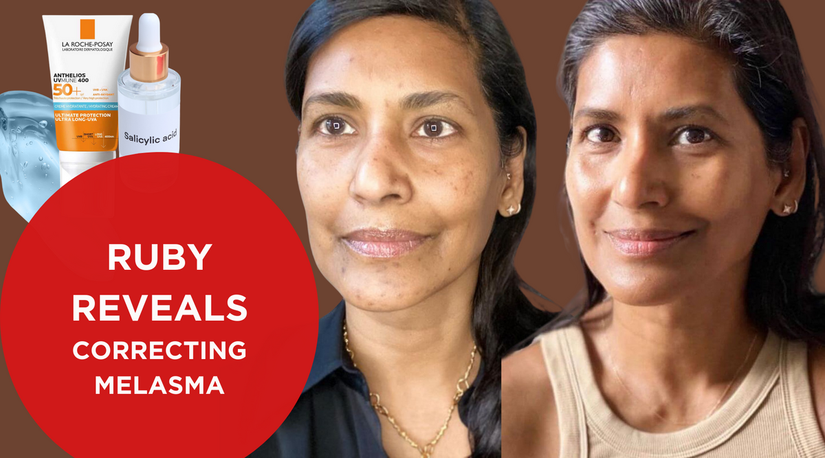 RUBY REVEALS: MANAGING MELASMA